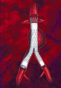 Endovascular aortic repair